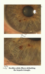 Swollen white fibers
