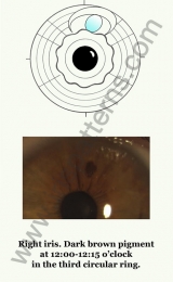 Hypophysis right iris