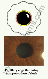 Pupillary edge
