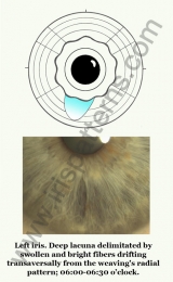 Uterus left iris