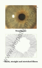 Neurogenic iris