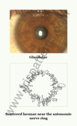 Glandular iris