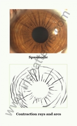 Spasmodic iris